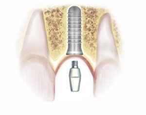 Diagram showing abutment attachment to implant in the gums