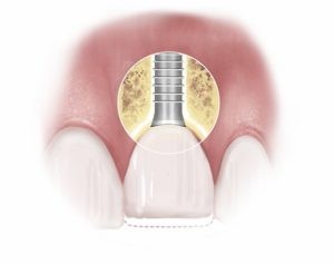 Diagram showing replacement tooth attached to implant in the gums
