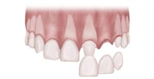 Diagram showing Tooth replacement with a bridge